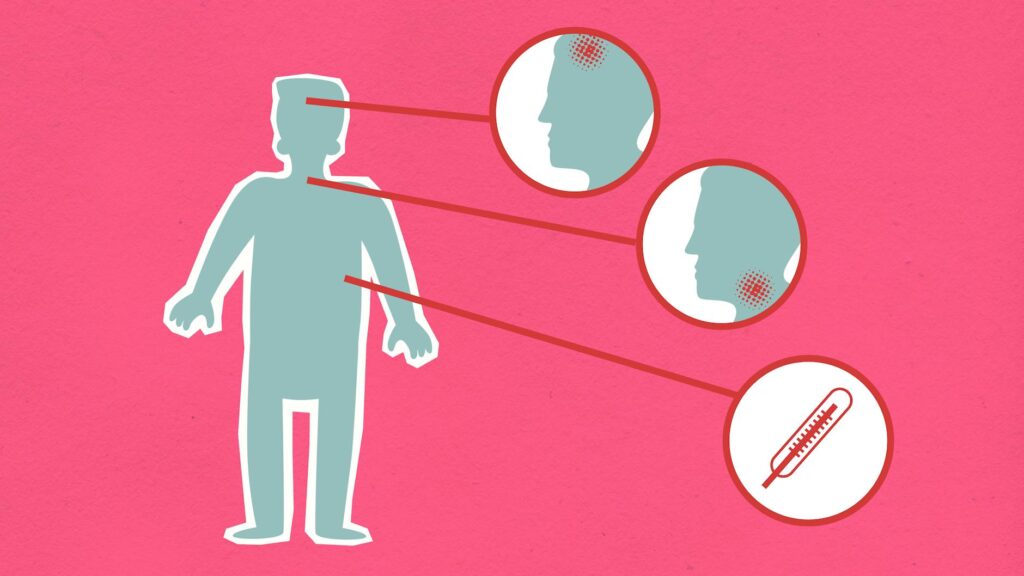 A diagram explaining whiplash and its effects on the neck. — whiplash settlement value