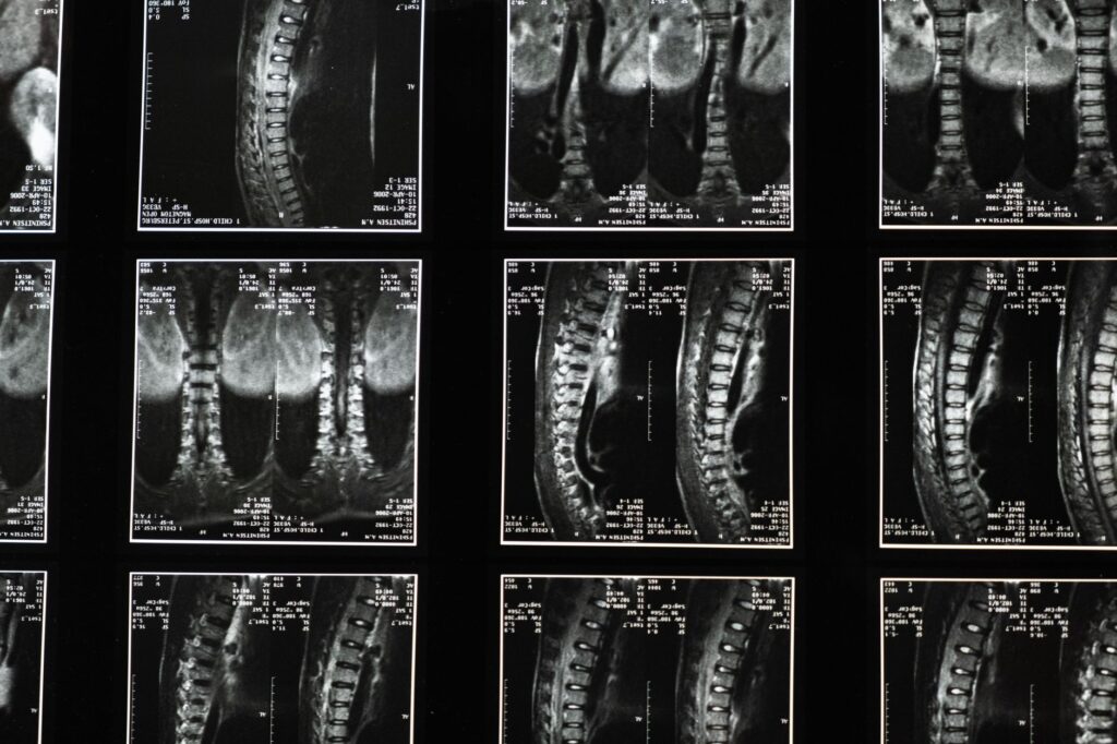 A comparison chart of factors influencing spinal injury compensation incorporating the back injury settlement calculator